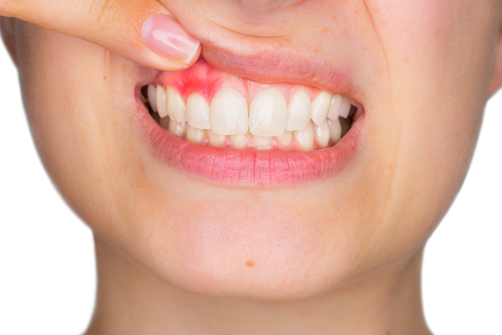 El 50% de las personas mayores de 30 años tiene periodontitis